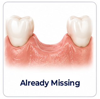 Dental Implants Already Missing