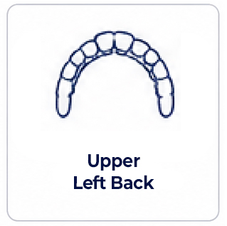 Upper left back of mouth dental implant review