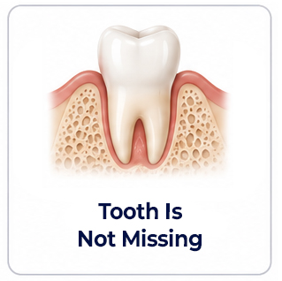 Dental Implants Tooth Still Present