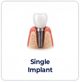 single dental implant