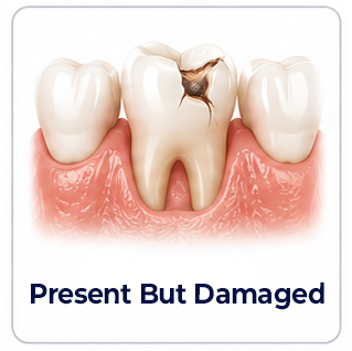 Dental Implants Present But Damaged