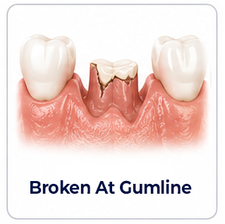 Dental Implants Damaged Below the Gumline
