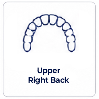 Upper Right Back of mouth dental implant review