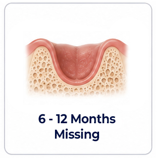 Dental Implants Tooth Missing 6-12 Months