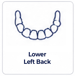 Lower Left Back of mouth dental implant review