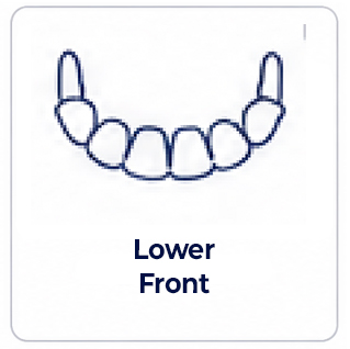 Lower Front of mouth dental implant review