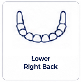 Lower Right Back of mouth dental implant review