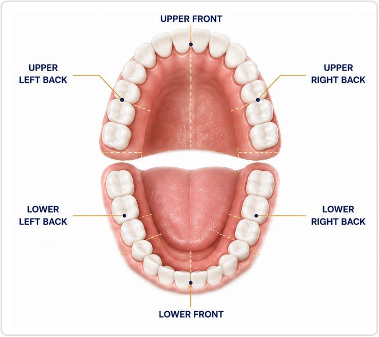 Dental implant bone loss illustration