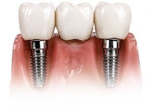 affordable-implantology-and-periodontic-over-bridge Affordable implkntonloy and periodontics over bridge