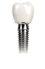 affordable-implantology-and-periodontics affordable implants single implant