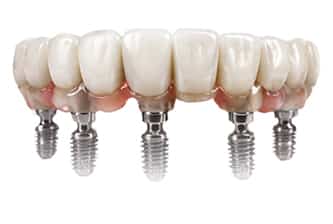 affordable-implants-all-on-5 Affordable implants all-on-5