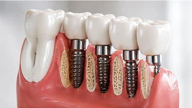 Periodontal Disease Treatment