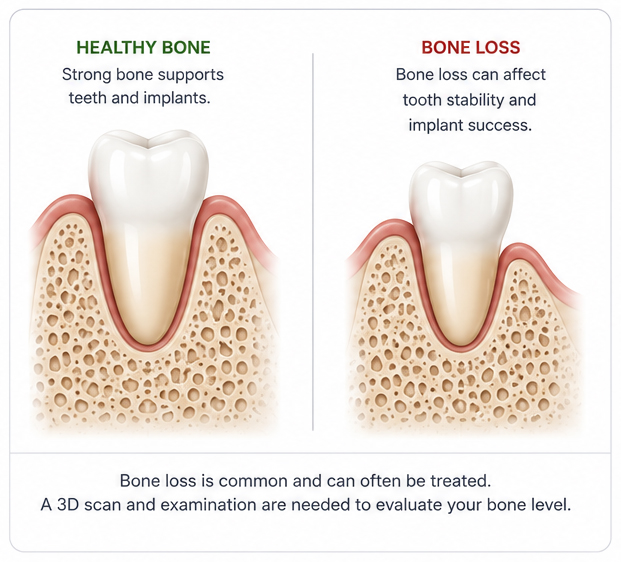 Dental implant bone loss illustration