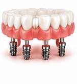 All-on-4 full arch dental implants