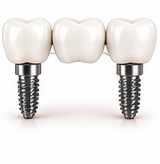 Dental implant bridge
