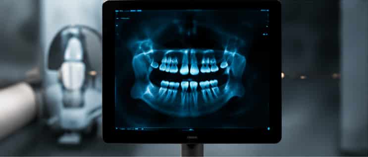 Bone grafting