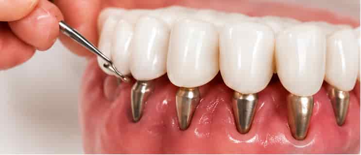Gum grafting