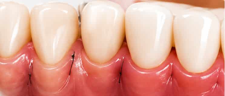 Periodontal maintenance