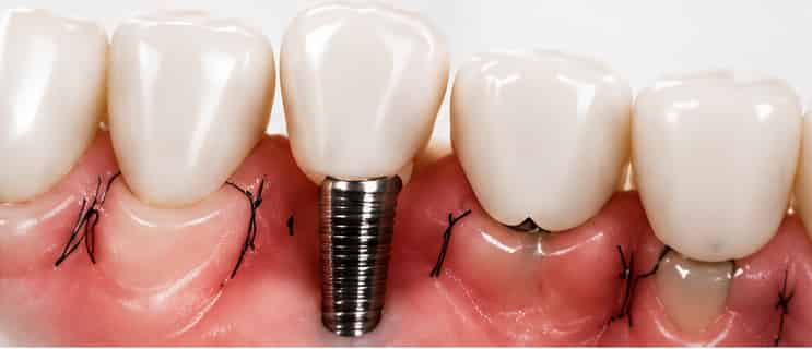 Soft tissue grafting