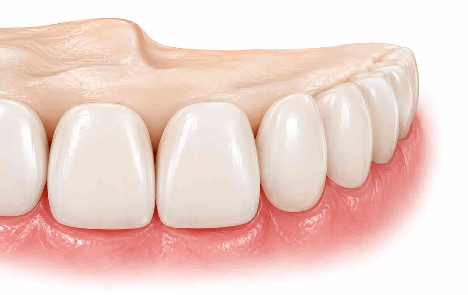 Dental implant teeth illustration