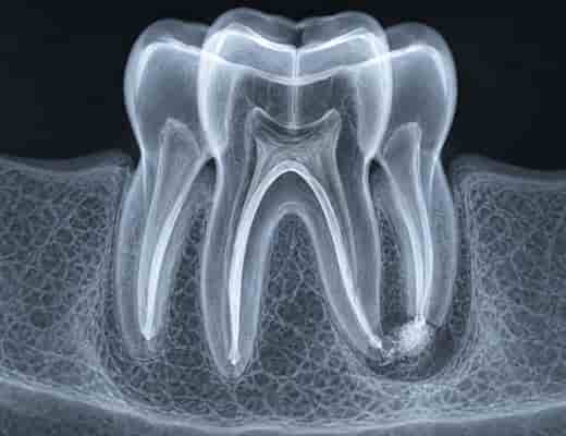 Bone grafting