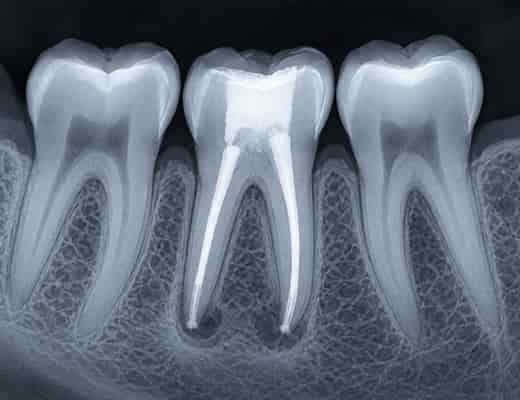 Periodontal maintenance