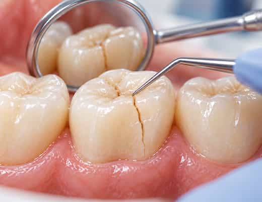 Gum grafting